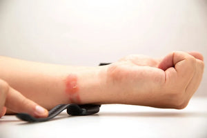 Watch Rash: Causes, Prevention, and Treatment